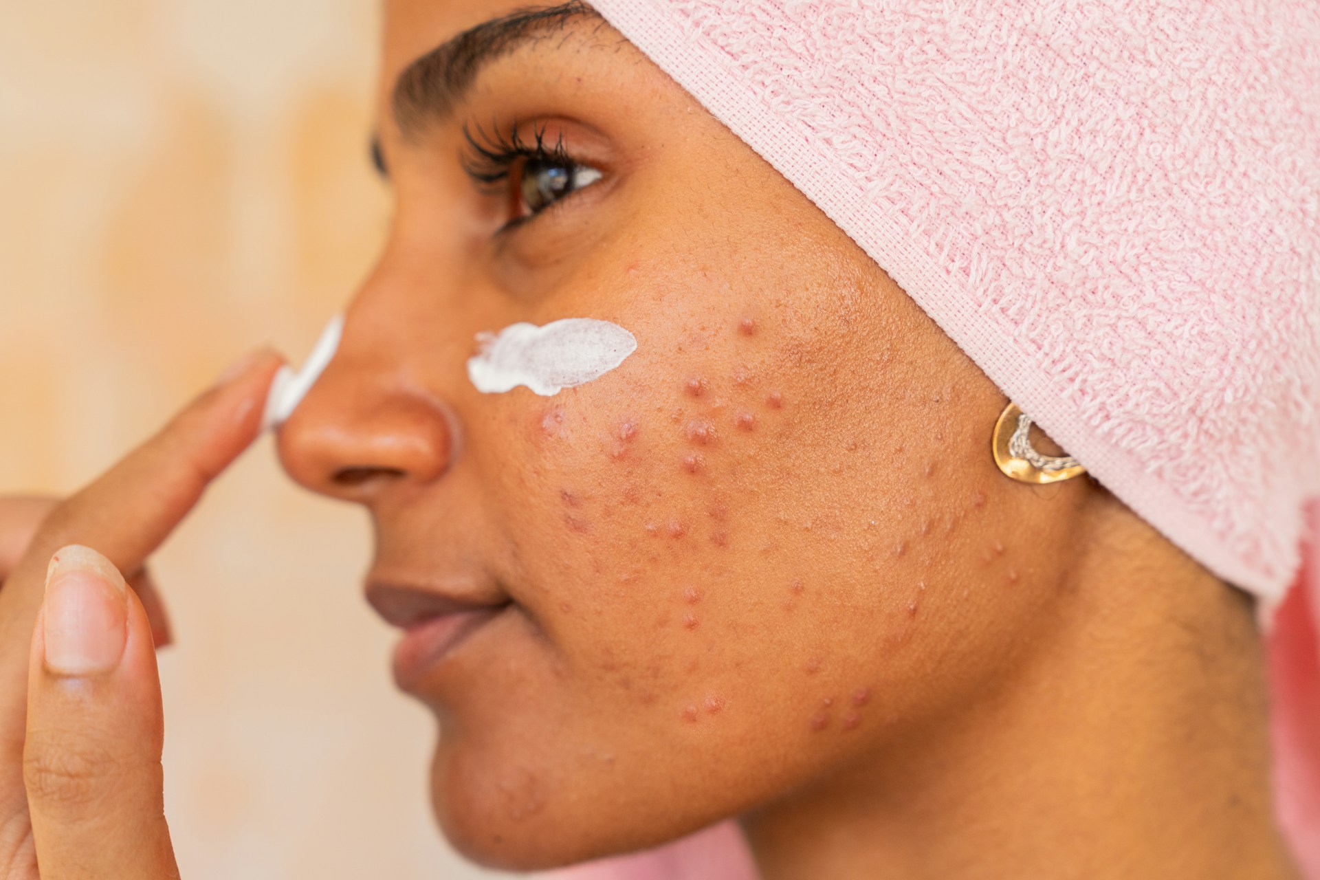 Do Facials Actually Help Acne?